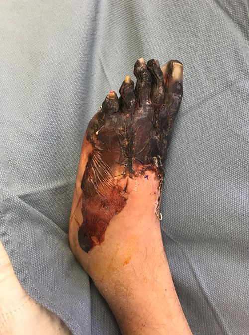 Patient's foot from tree limb accident before surgery